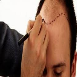 mina hair clinic saç ekim merkezi