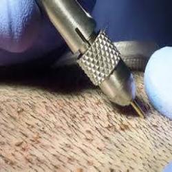 mina hair clinic saç ekim merkezi