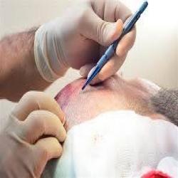 mina hair clinic saç ekim merkezi